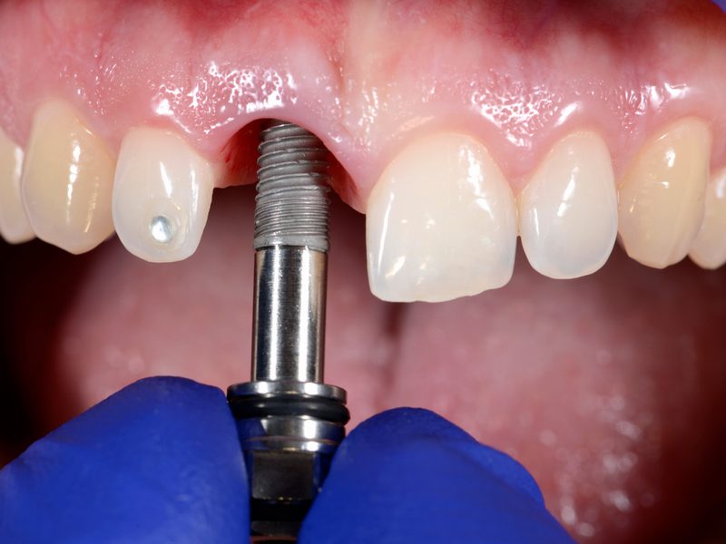 Implante dental que reemplaza la raíz de un diente perdido