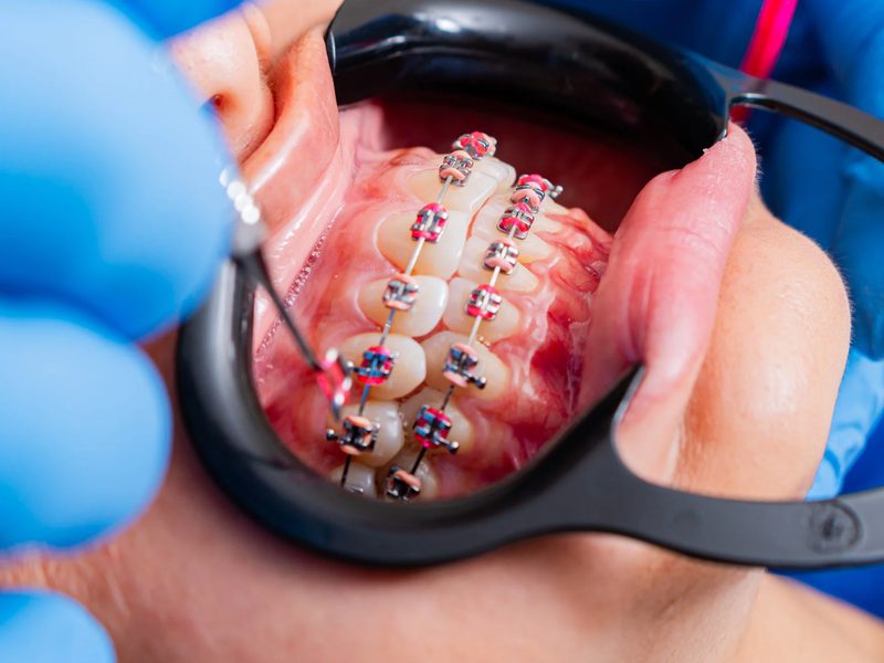 Tratamiento de ortodoncia con brackets y alineadores