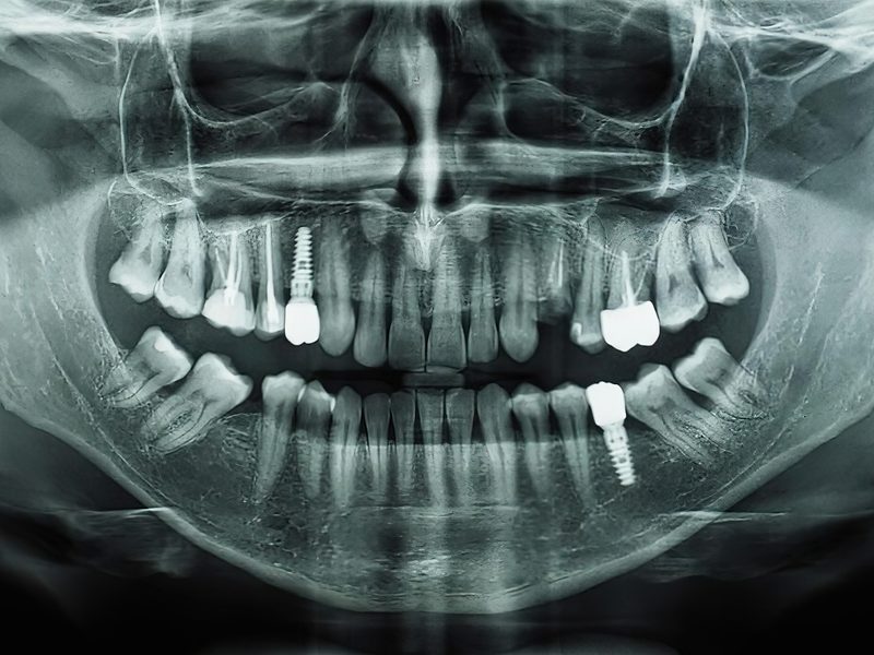 Radiología dental digital de alta definición